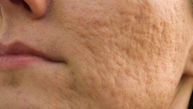 Sivilce Nedir? Sivilce Lekelerine Ne İyi Gelir?  Sağlık